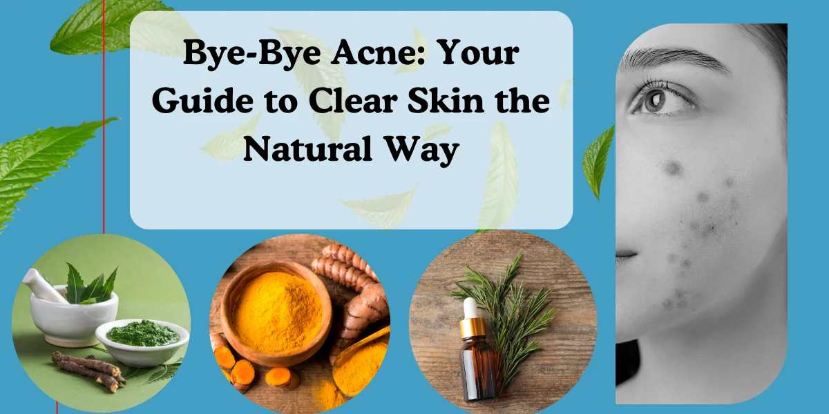 Bye-Bye Acne: Your Guide to Clear Skin the Natural Way